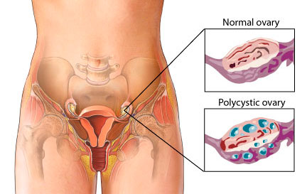 Normal Ovary compared to Polycystic Ovary